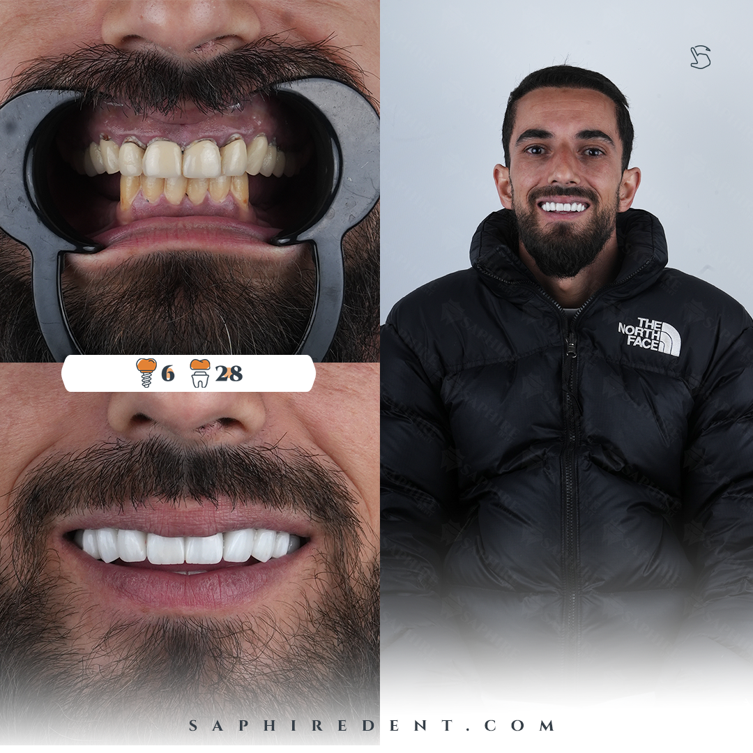 Dental Implants